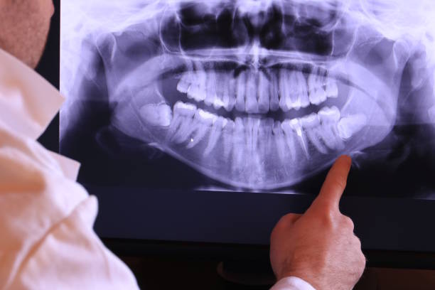 Best Emergency Dentist for Lost Fillings or Crowns in Westmere, NY